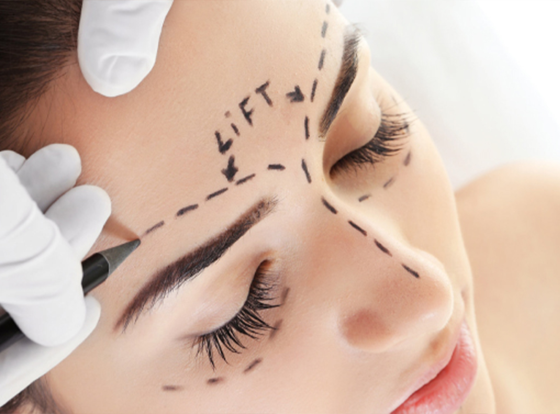 Kaş Kaldırma (Brow Lift)