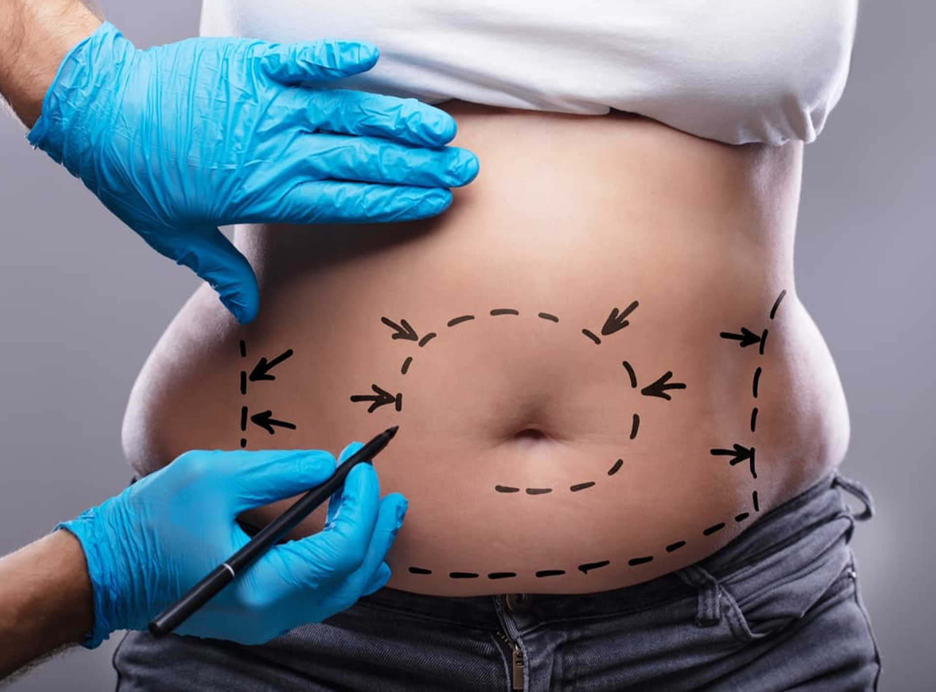 Karın Germe (Abdominoplasti)