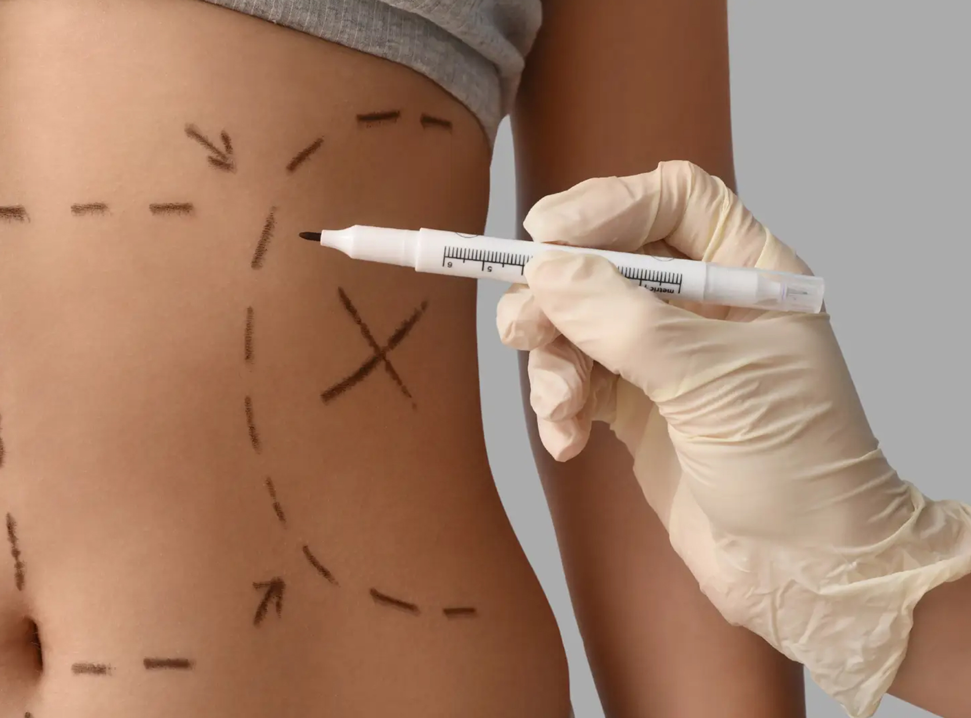 Ters Karın Germe (Reverse Abdominoplasti)